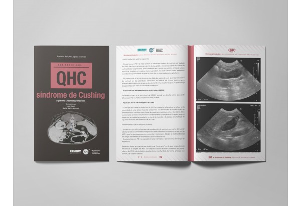 Revista QHC Síndrome de Cushing -Colecciones