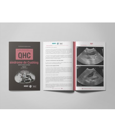 Revista QHC Síndrome de Cushing -Colecciones